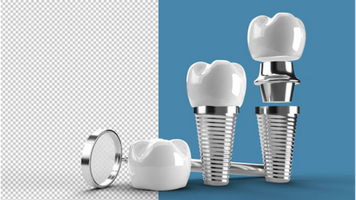 The Benefits of Modern Dental Prosthetics